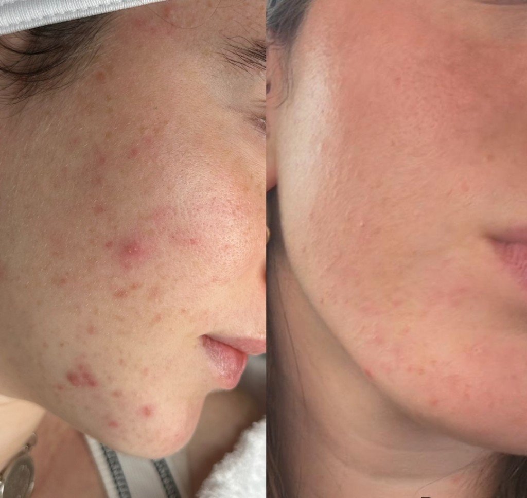 השוואת לפני ואחרי טיפול