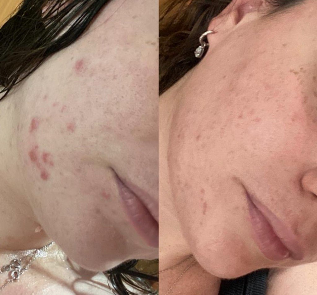 השוואת לפני ואחרי טיפול