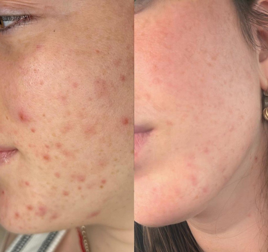 השוואת לפני ואחרי טיפול