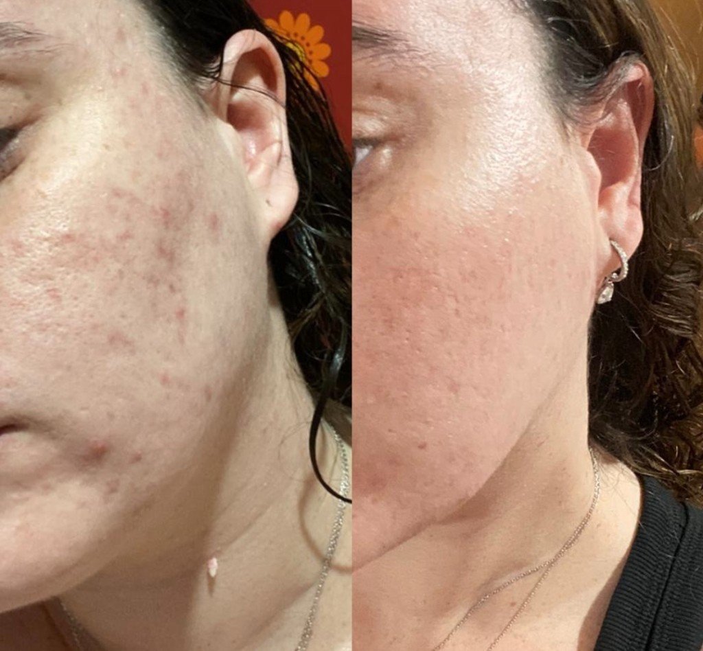 השוואת לפני ואחרי טיפול